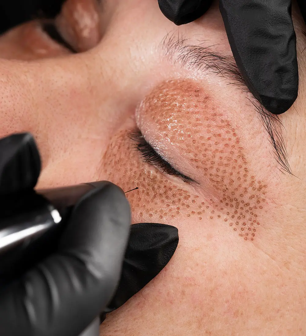 Plasma Pen Treatment in Llandudno
