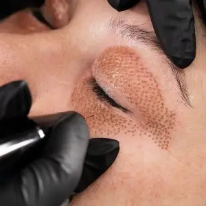 Plasma Pen Treatment in Llandudno