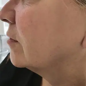 Jaw Line Contouring at Dermatox Aesthetics